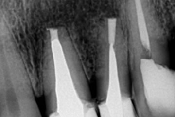 Cirurgia Parendodôntica